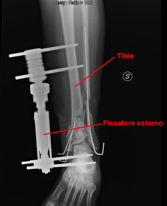 Intervento Chirurgico Per La Frattura Della Tibia Scomposta E Post