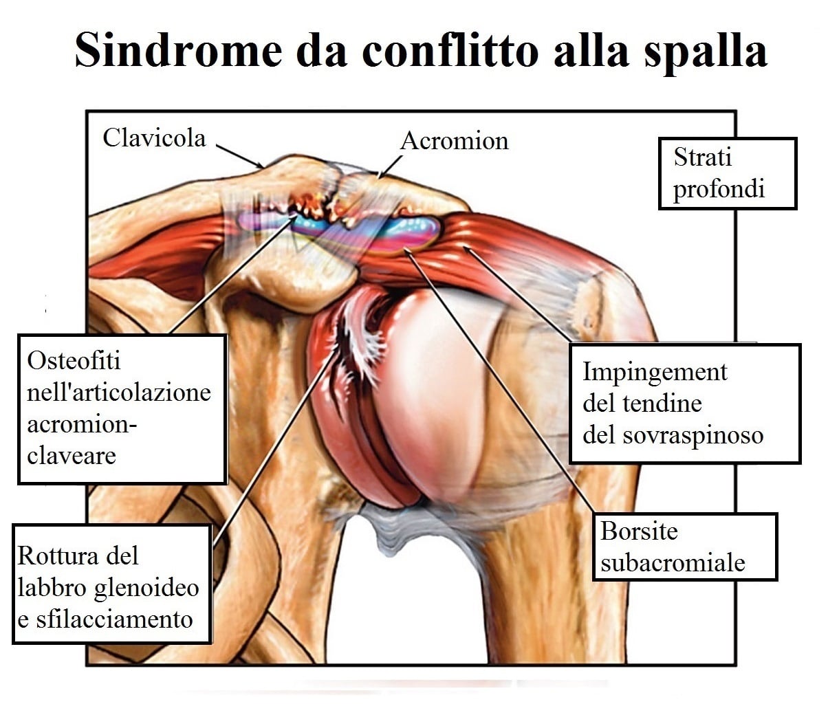 Dolore Alla Scapola Sinistra O Destra