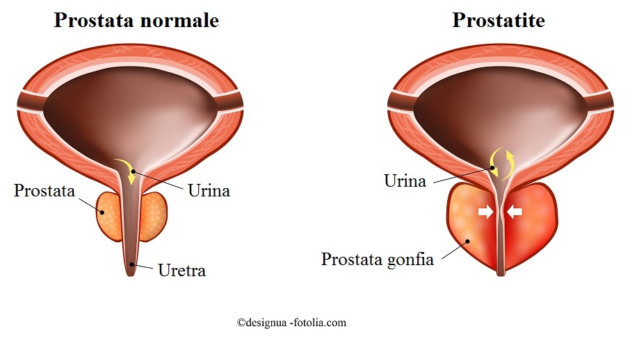 Infiammazione Alla Prostata Sintomi Rimedi E Terapia