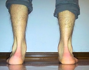 iperpronazione piede
